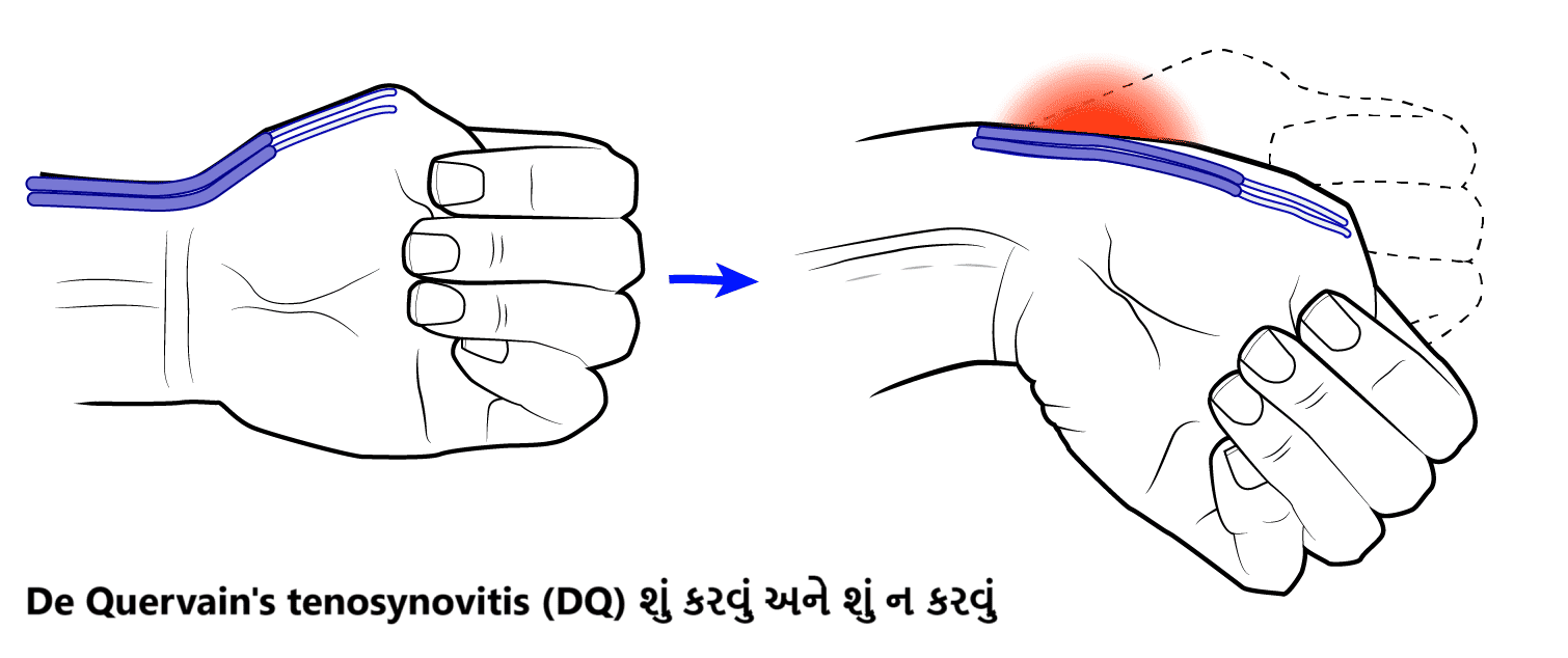 De Quervain's tenosynovitis (DQ) શું કરવું અને શું ન કરવું