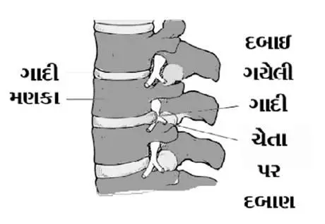 કમરની ગાદીનો દુખાવો