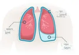 ફેફસામાં પાણી ભરાવું