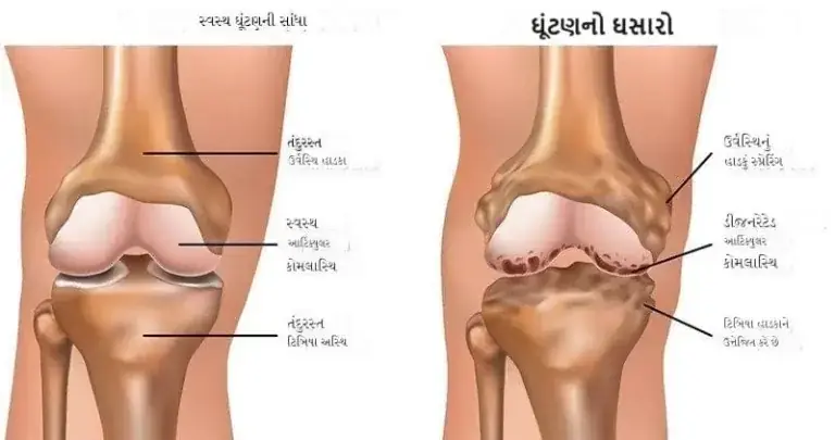 હાડકા નો ઘસારો