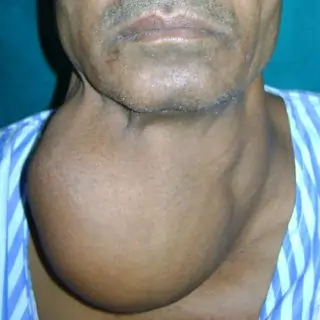 ગરદન માં સોજો