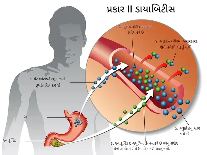 પ્રકાર 2 ડાયાબિટીસ