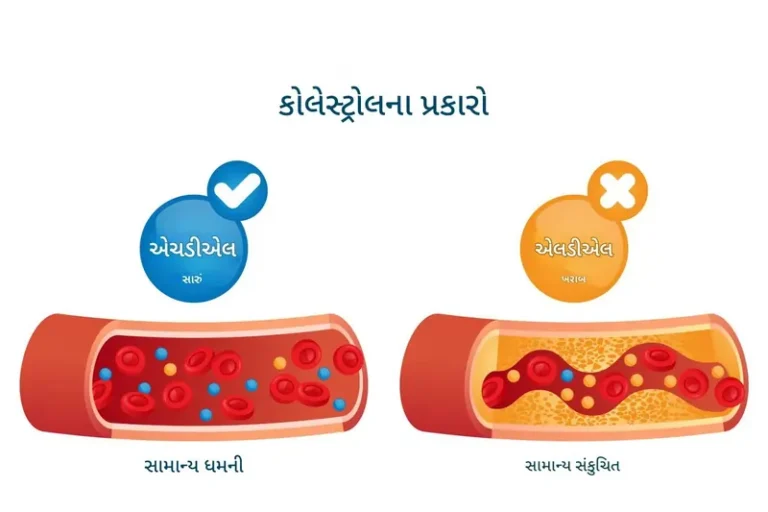 LDL કોલેસ્ટ્રોલ
