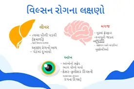 વિલ્સન રોગ