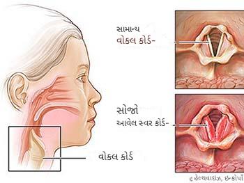 અવાજ બેસી ગયો હોય તો શું કરવું