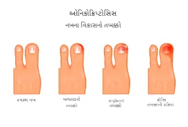 ઇનગ્રોન ટોનેઇલ