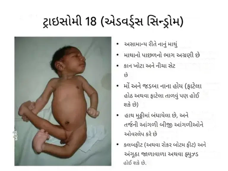 એડવર્ડ્સ સિન્ડ્રોમ