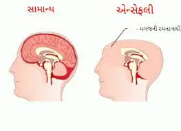 એનેન્સફાલી