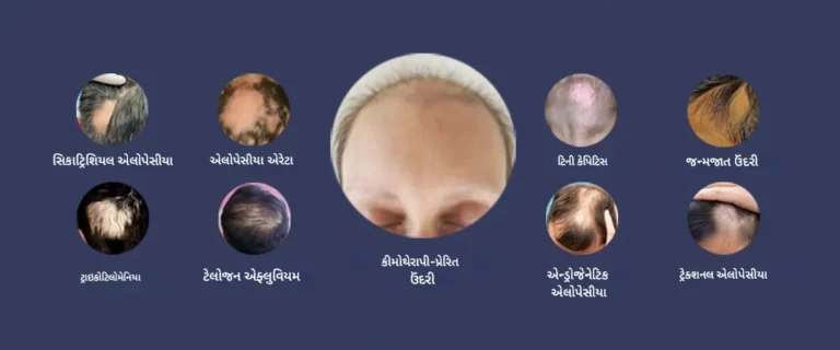 એન્ડ્રોજેનેટિક એલોપેસિયા