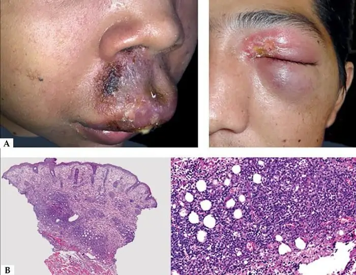 એપસ્ટેઇન-બાર વાયરસ