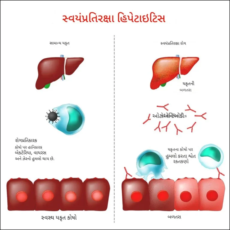 ઓટોઇમ્યુનહેપેટાઇટિસ