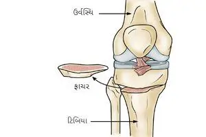 ઓસ્ટિયોટોમી