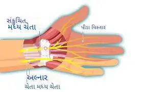 કાંડામાં ચેતાનું સંકોચન