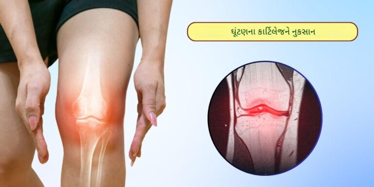 કાર્ટિલેજનોઘસારો