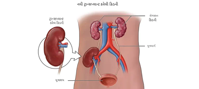 કિડની ટ્રાન્સપ્લાન્ટ
