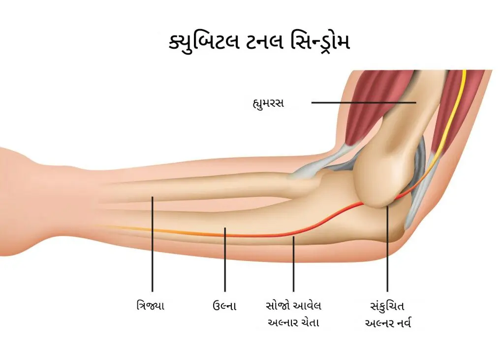 ક્યુબિટલ ટનલ રિલીઝ