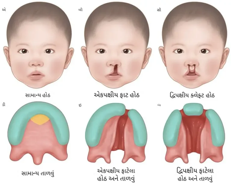ક્લેફ્ટ હોઠ અને/અથવા તાળવું