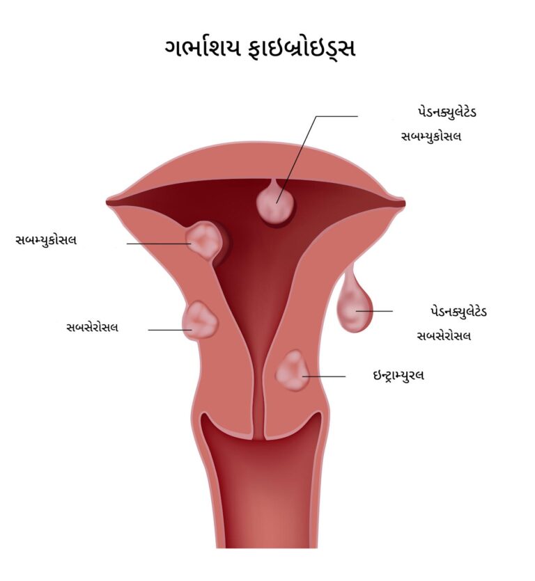 ગર્ભાશયના ફાઇબ્રોઇડ્સ