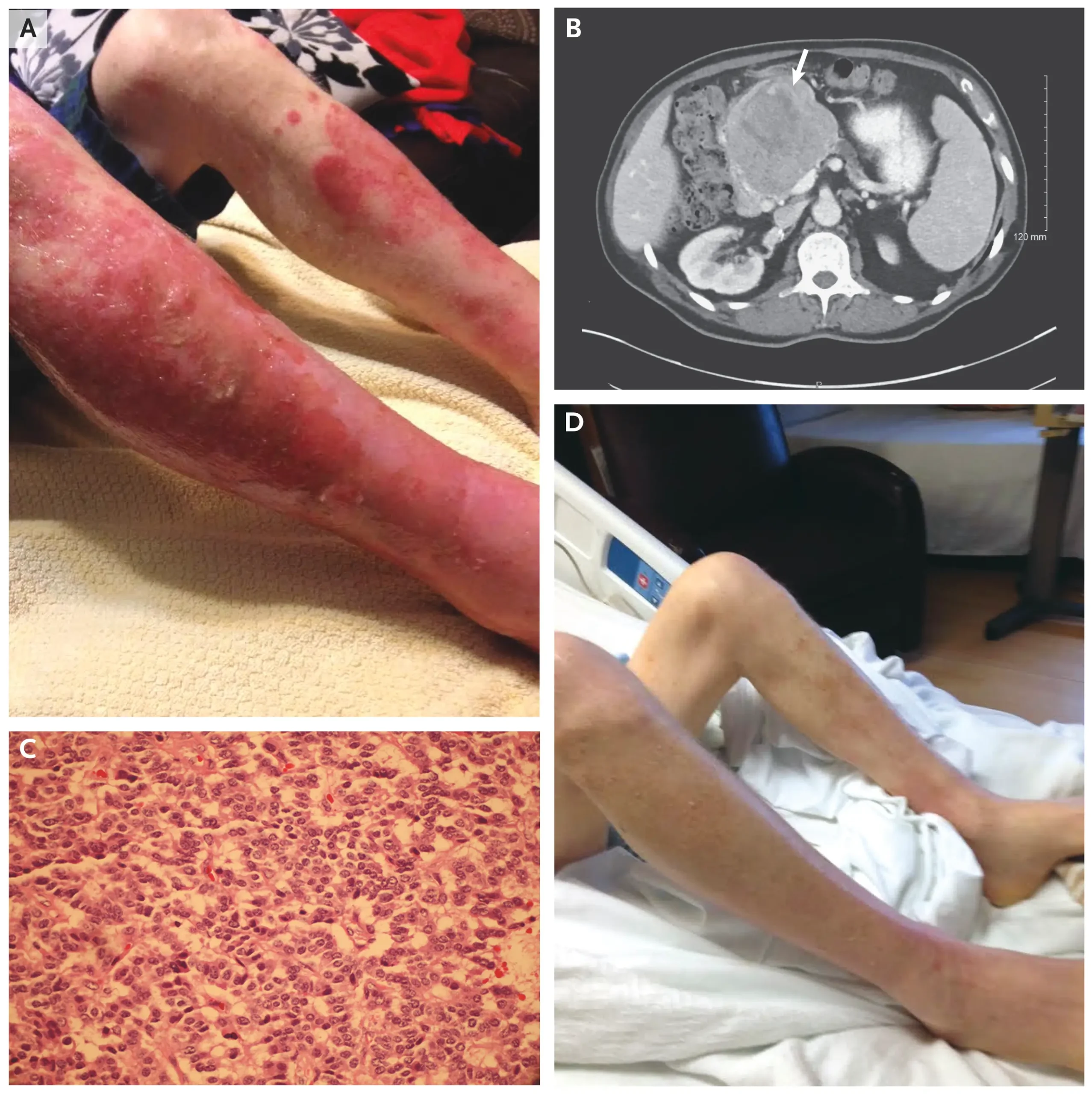 ગ્લુકાગોનોમા