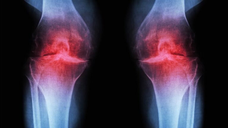 ઘુટણ નો ઘસારો