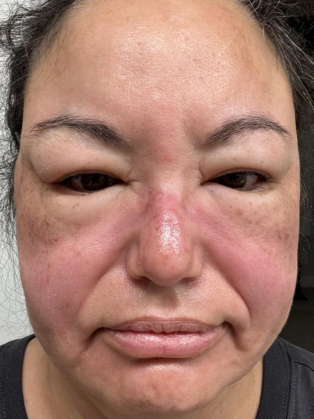 ચહેરા પર સોજો આવવાનું કારણ