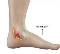ટાર્સલ ટનલ સિન્ડ્રોમ