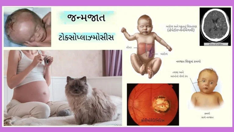 ટોક્સોપ્લાઝ્મોસિસ