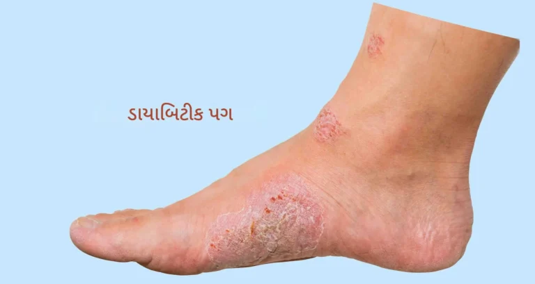 ડાયાબિટિક ફૂટ