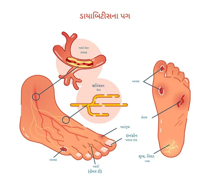 ડાયાબિટીક અલ્સર