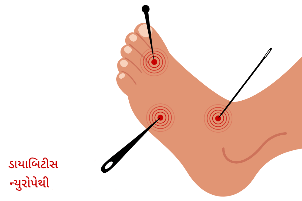 ડાયાબેટીક ન્યુરોપથી