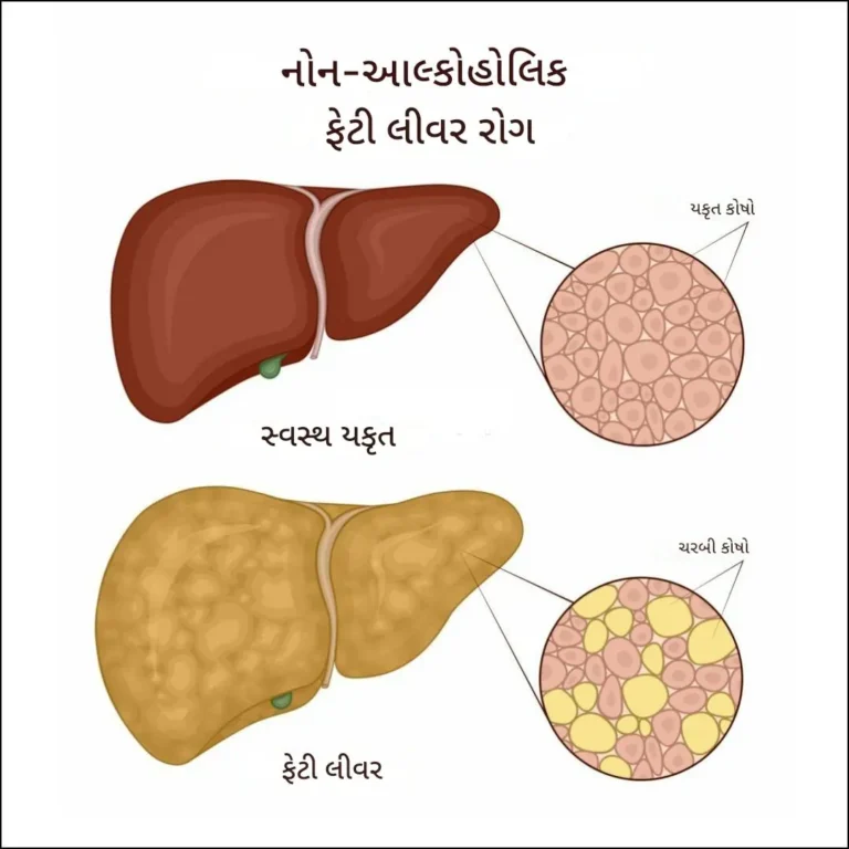નોન-આલ્કોહોલિકફેટીલિવરડિસીઝ