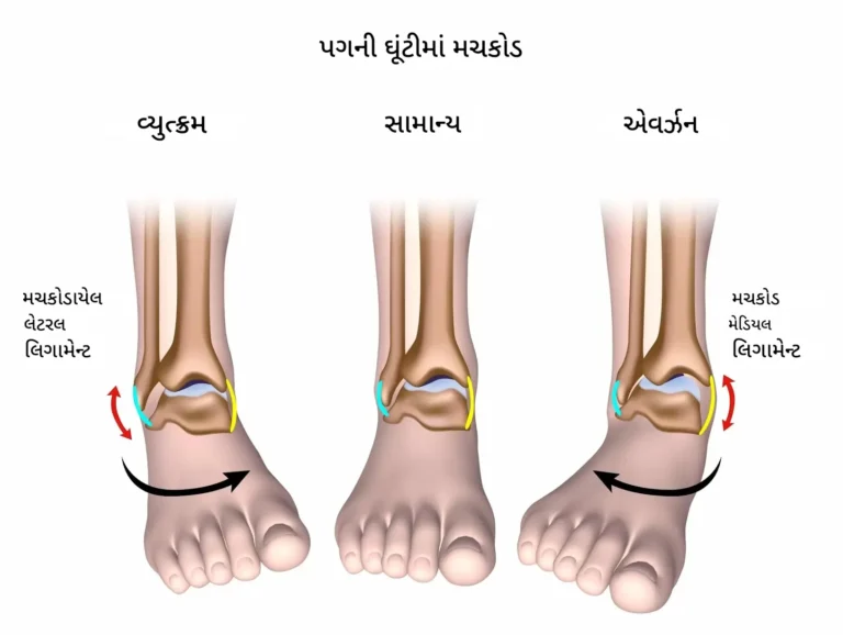 પગની ઘૂંટી માં મચકોડ