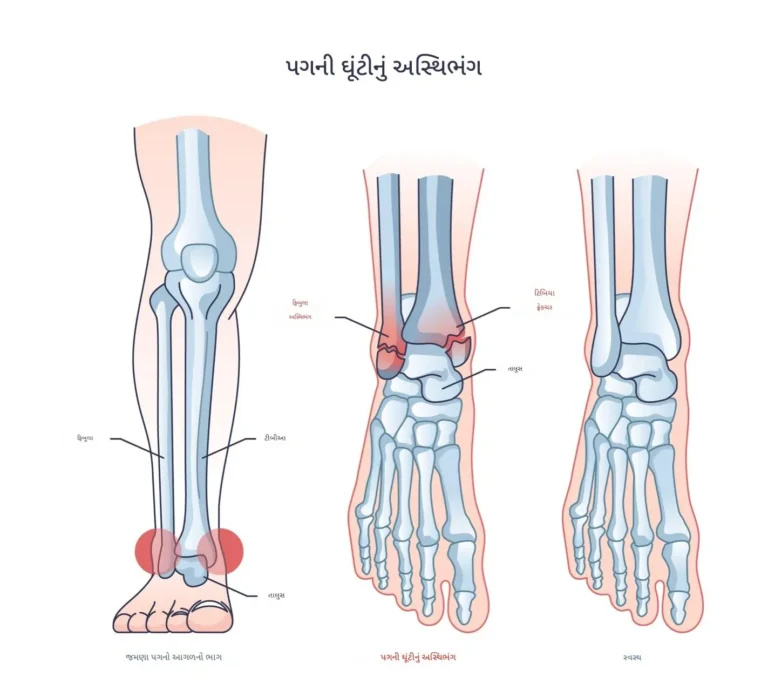 પગની ઘૂંટીમાં ફ્રેક્ચર