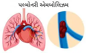 પલ્મોનરી એમ્બોલિઝમ (PE)