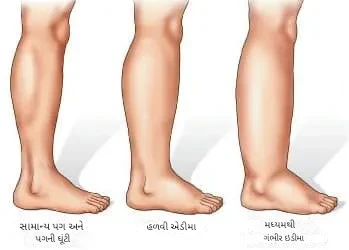 પિટિંગ એડીમા