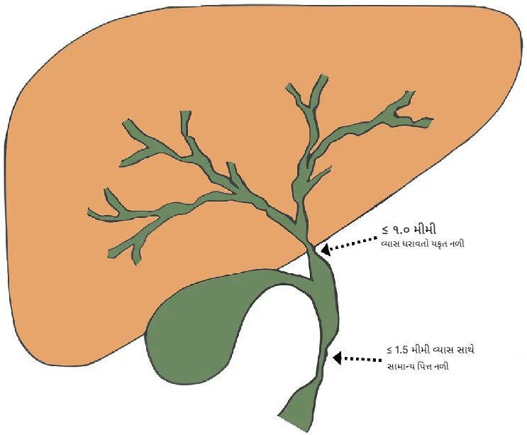 પિત્તનળી નું સંકોચન