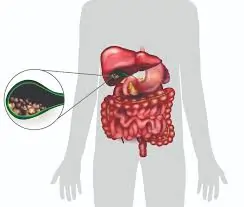 પિત્તાશયની પથરી