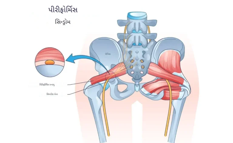 પિરીફોર્મિસ સિન્ડ્રોમ