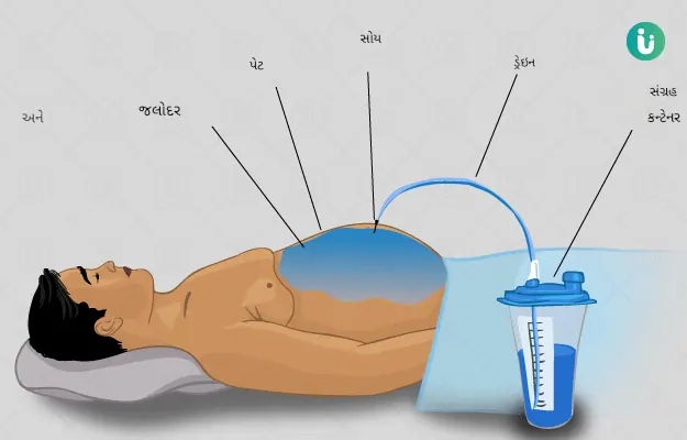 પેટનાપ્રવાહીનુંપરીક્ષણ