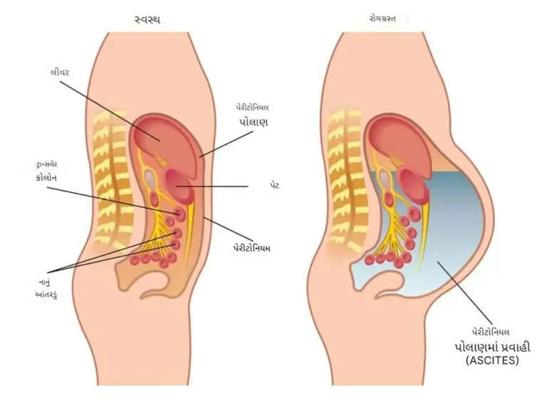 પેટમાં પ્રવાહી જમા થવું (Ascites)