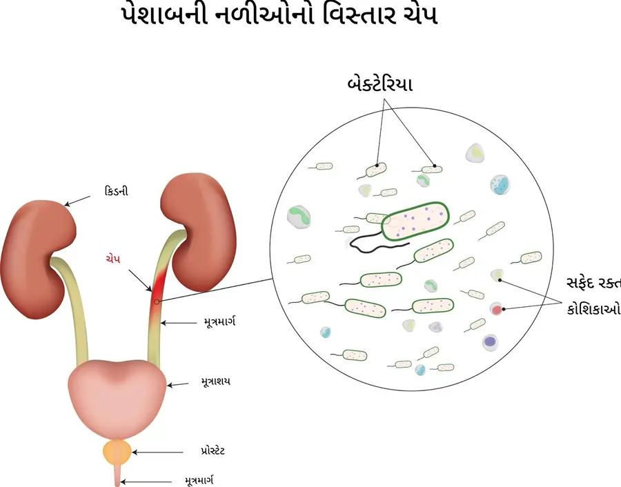 પેશાબના માર્ગ માં ચેપ