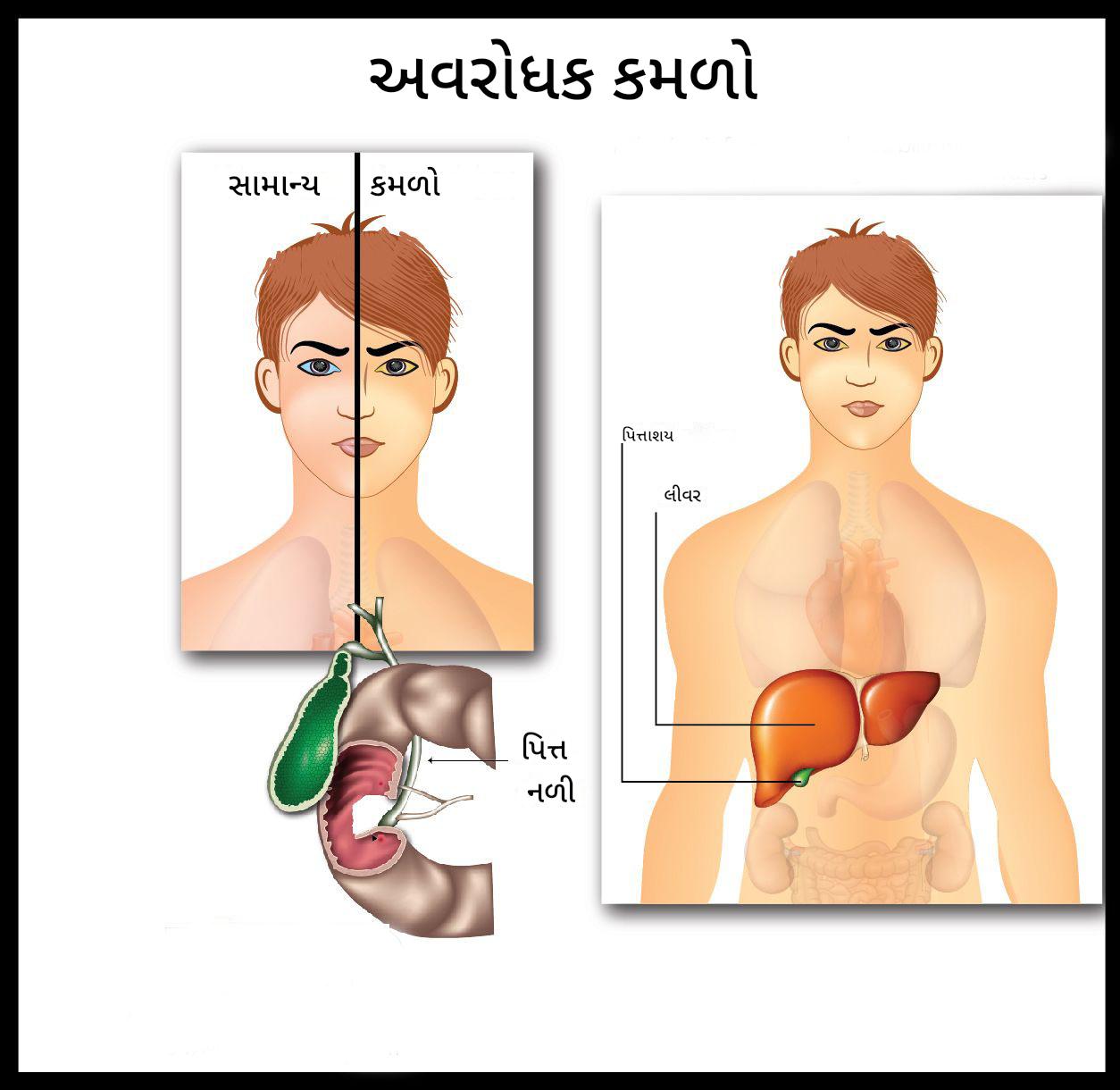 પોસ્ટ-હેપેટિક કમળો