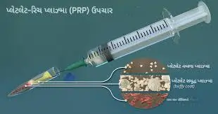પ્લેટલેટ-રીચ પ્લાઝ્મા (PRP) ઇન્જેક્શન્સ