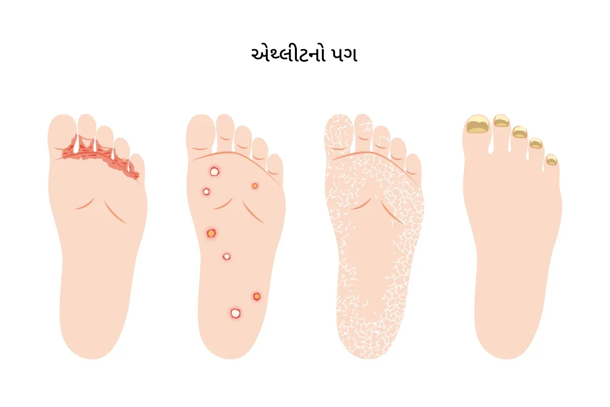 ફંગસ (ફૂગ) નુંસંક્રમણ