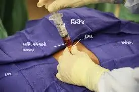 બોન મેરો એસ્પિરેશન