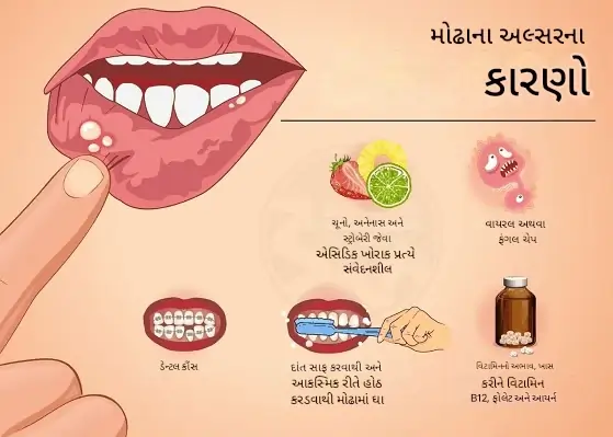 મોઢામાંછાલાપડવાનુંકારણ
