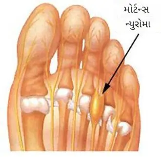 મોર્ટન ન્યુરોમા