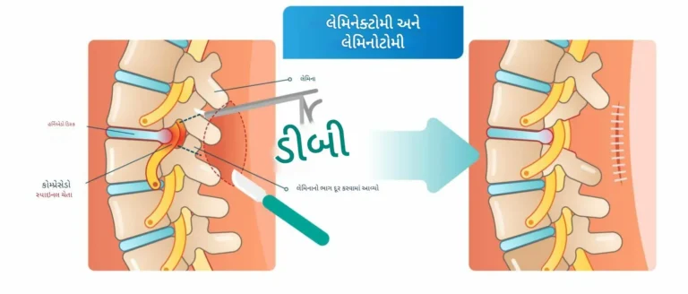લમ્બર લેમિનેક્ટોમી અથવા ડિસ્કેક્ટોમી