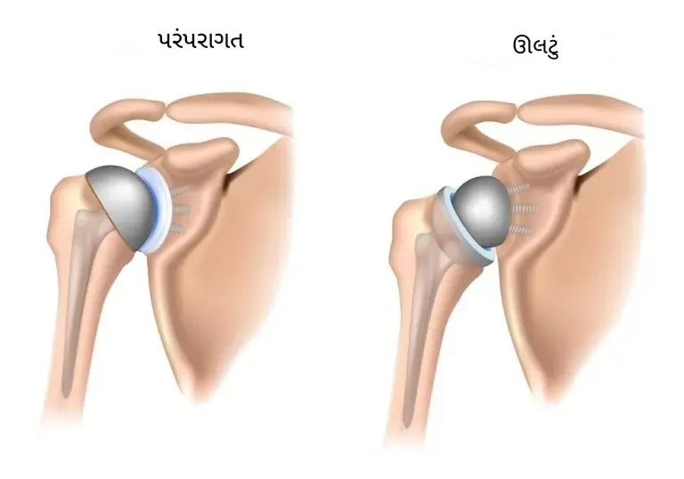 શોલ્ડર સાંધા રિપ્લેસમેન્ટ