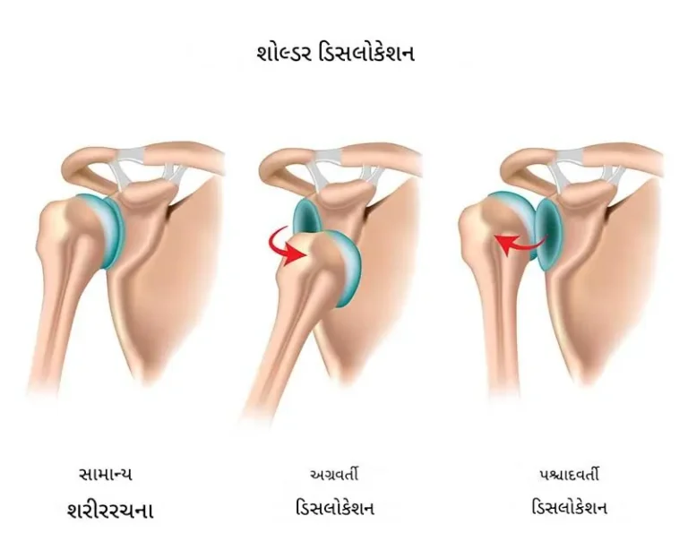 સાંધાના ડિસલોકેશન